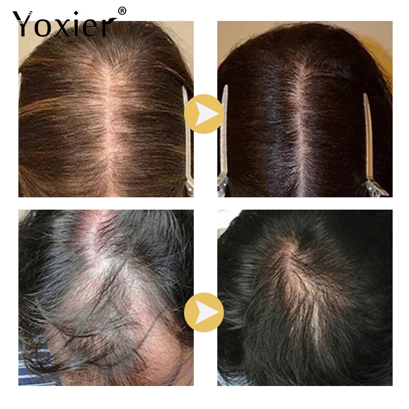 Soro de crescimento intensivo  - Hair Care For Hair Loss avaliação e preço